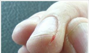Lëkura e plasaritur në gishta pranë thonjve: shkaqet dhe trajtimi