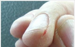 Piele crăpată de pe degete lângă unghii: cauze și tratament