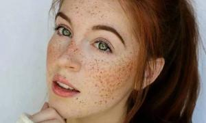 Manchas de pigmento: causas de aparición en la cara y el cuerpo, fotos, tratamiento en el hogar. Pigmentación en la cara en primavera, causas y tratamiento.